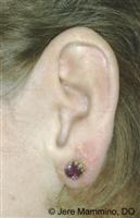 Nickel+contact+dermatitis+pictures